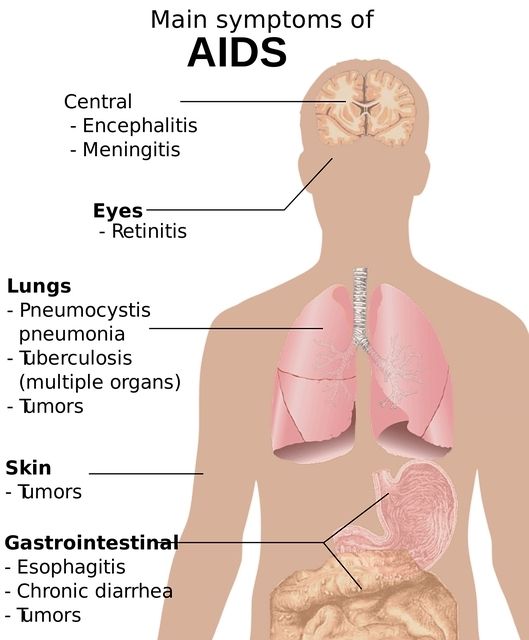 AIDS Full Form in Hindi